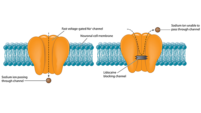 Sodium channel blocker treatment diagram